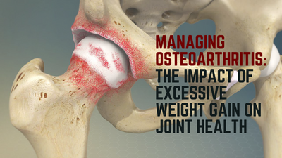 Managing Osteoarthritis: The Impact of Excessive Weight Gain on Joint Health